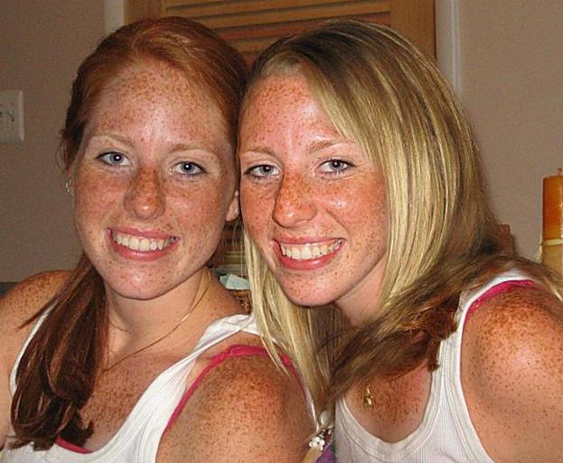 Freckles increase the risk of skin damage after sun exposure