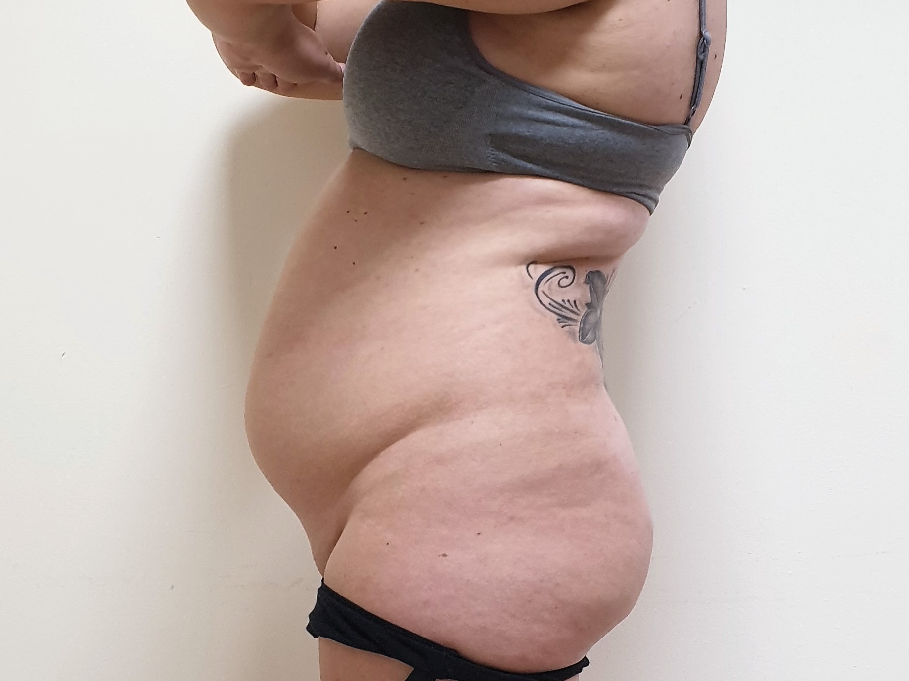 https://castleknockcosmetics.ie/wp2/wp-content/uploads/2023/04/loose-abdominal-divarification-diastasis-not-suitable-liposuction.jpg