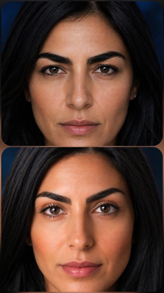 Botox eyebrow lift