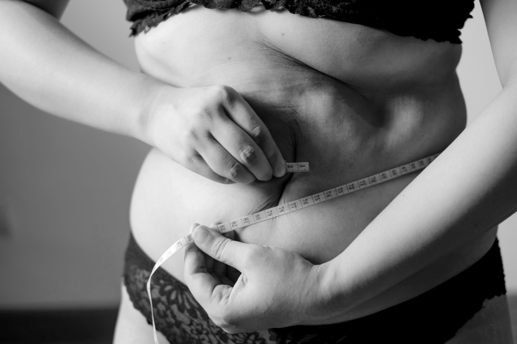 loose skin cinched waistline vaser liposuction clinic dublin