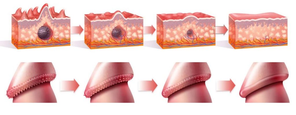Grading of PPP removal Dublin, treated with laser co2 or plasma PPP treatment Dublin Ireland, white bumps on penis, plasma