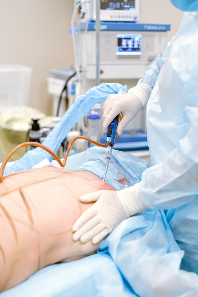 VASER liposuction for bulges after tummy tuck