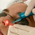 Facial thread veins treated with vascular laser at Dublin Castleknock Cosmetic Clinic