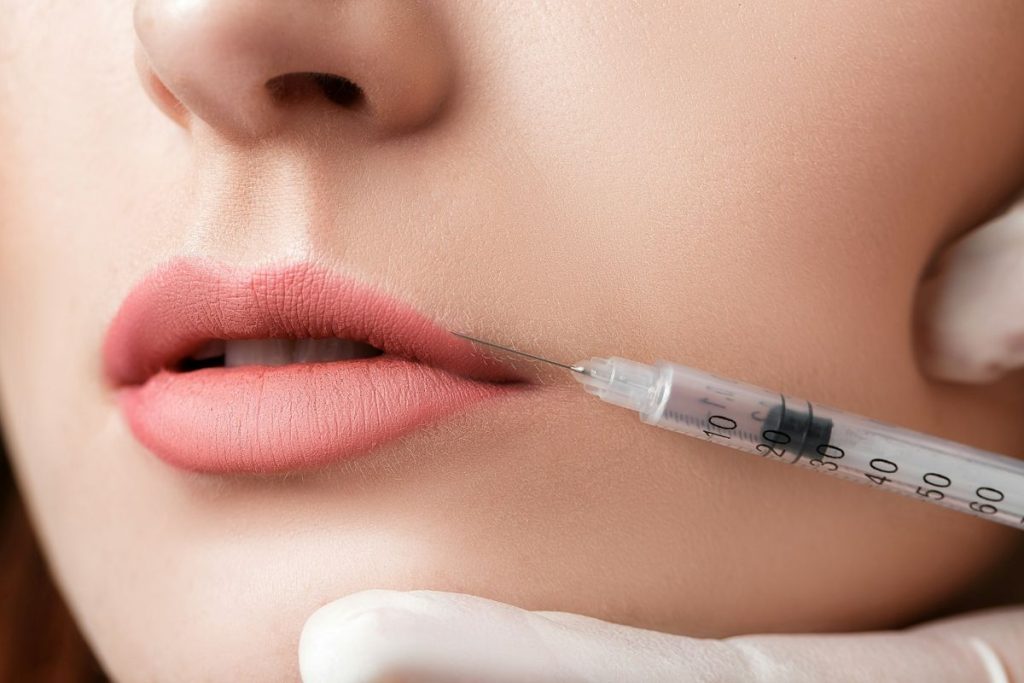 Botulinum toxin being carefully injected into the upper lip during a lip flip treatment at Castleknock Cosmetic Clinic Dublin
