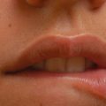 Woman with natural-looking fuller upper lip following a lip flip with botulinum toxin