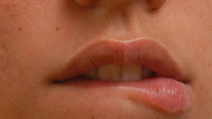 Lip Flip with Botulinum Toxin: 5 Things to Know Before Treatment