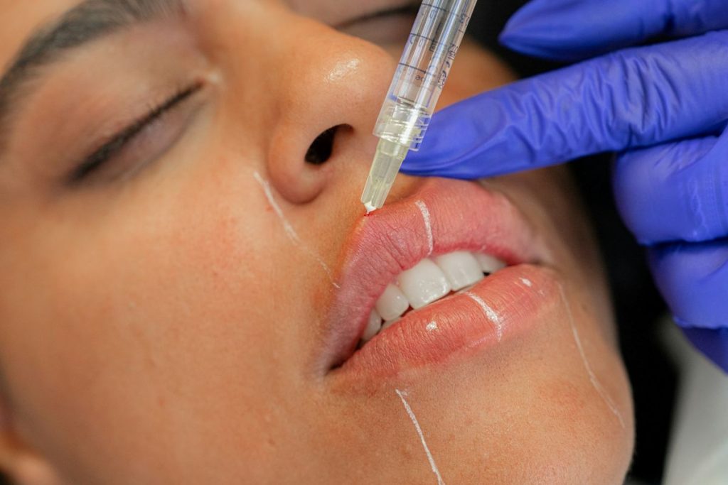 Botulinum toxin being carefully injected into the upper lip during a lip flip treatment