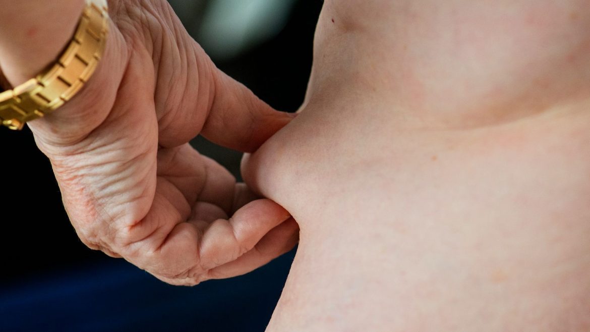 Dog Ears After a Tummy Tuck: The Pucker at the Scar Ends