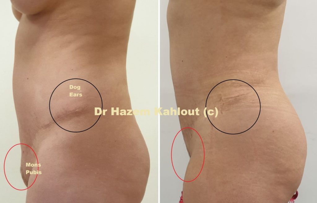 Dog ears and Mons Pubis FUPA after tummy tuck abdominoplasty repaired with VASER liposuction and Renuvion Skin Tightening