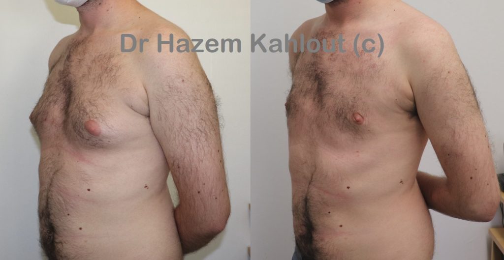 Gynecomastia surgery Dublin puffy nipples small cut excision before and after VASER, front view